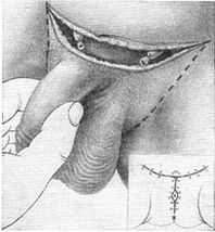 Chirurgische Verlängerung des Penis durch Herausziehen seines verborgenen Teils